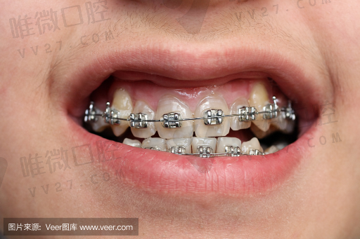 固定假牙怎样区别好坏呢,固定假牙是什么样子的(图1)